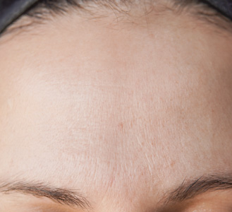 Forehead before using SiO Patches